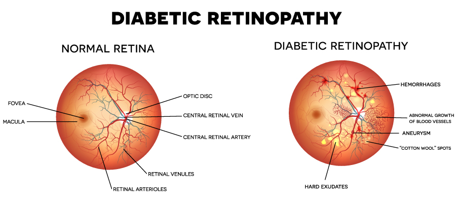 diabetic retinopathy example