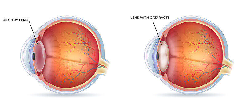 Healthy Lens vs. Lens with Cataracts