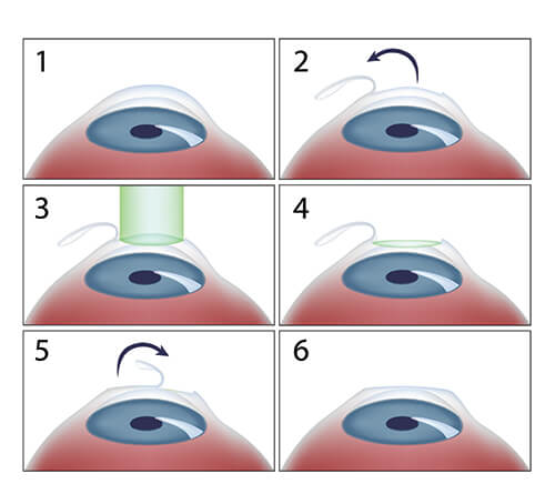Lasik center clearance