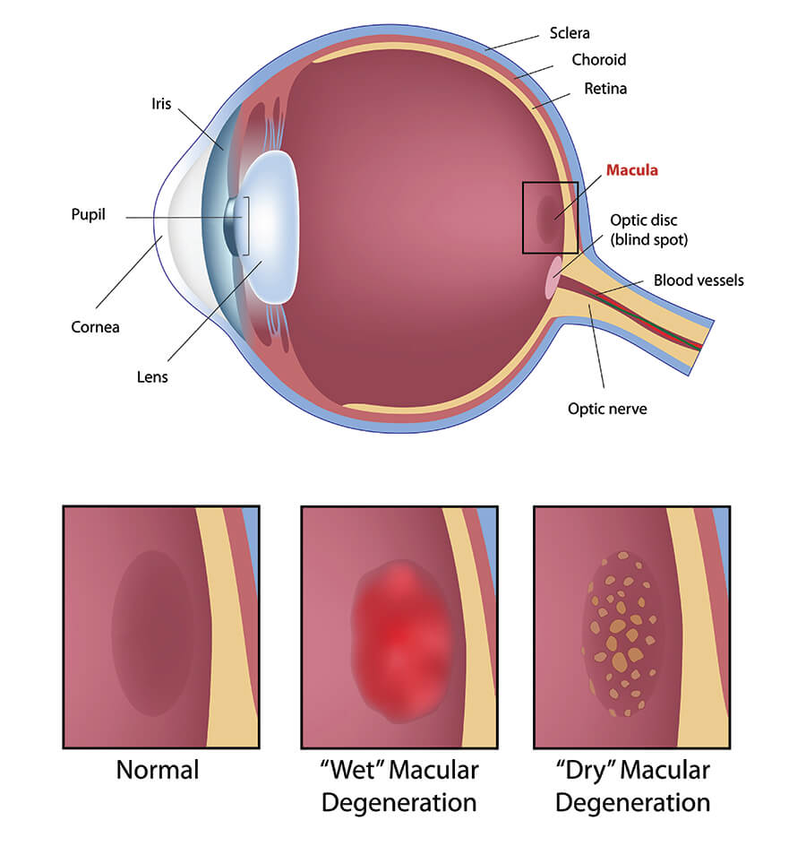 Chart Showing How Macular Degeneration Affects the Eye